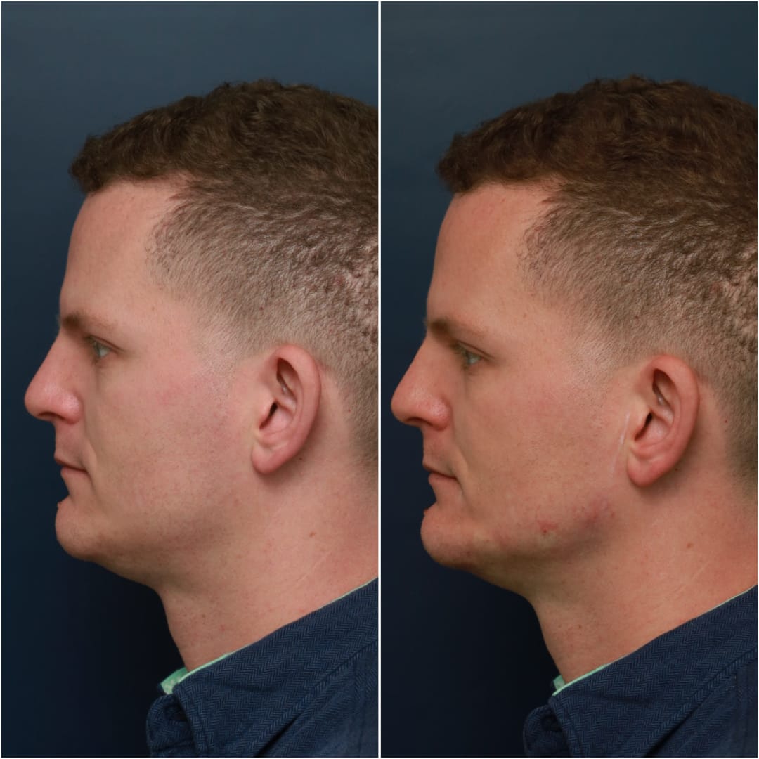 Chin & Jawline Contouring Before & After Gallery - Patient 58233219 - Image 1