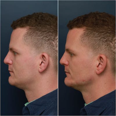 Jawline Contouring Before & After Gallery - Patient 58233219 - Image 1