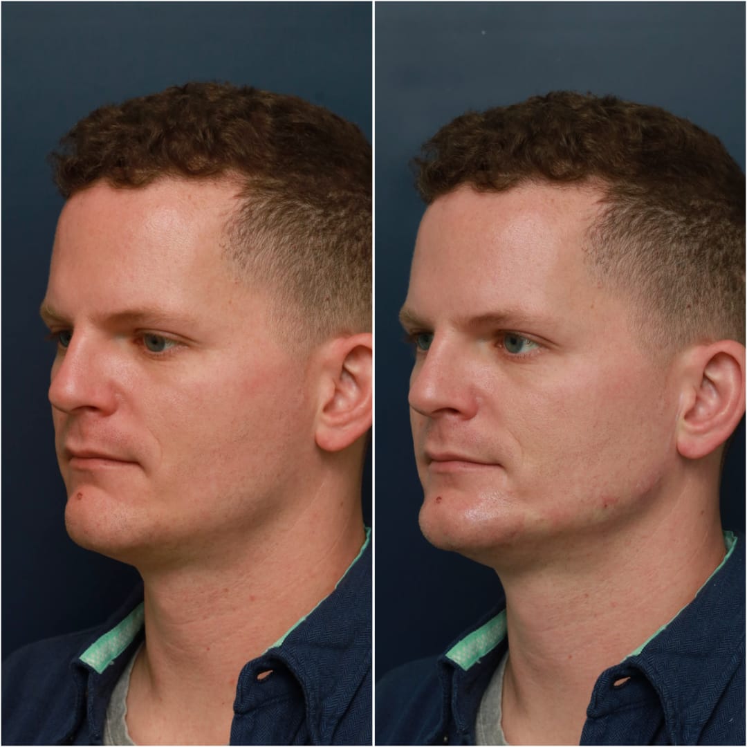 Chin & Jawline Contouring Before & After Gallery - Patient 58233219 - Image 2