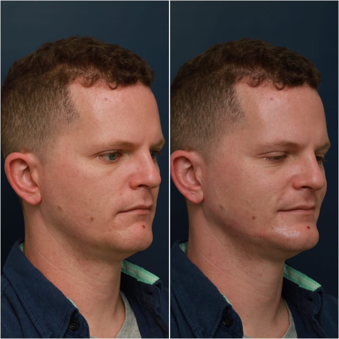 Chin & Jawline Contouring Before & After Gallery - Patient 58233219 - Image 3
