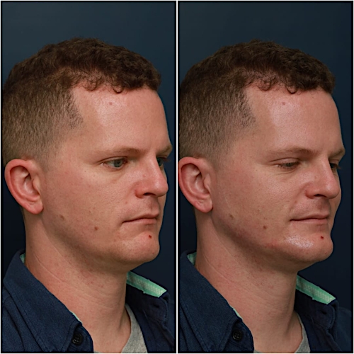 Jawline Contouring Before & After Gallery - Patient 58233219 - Image 3