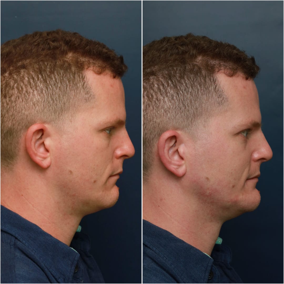 Chin & Jawline Contouring Before & After Gallery - Patient 58233219 - Image 4