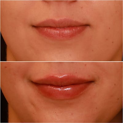 Lip Fillers Before & After Gallery - Patient 58233220 - Image 1