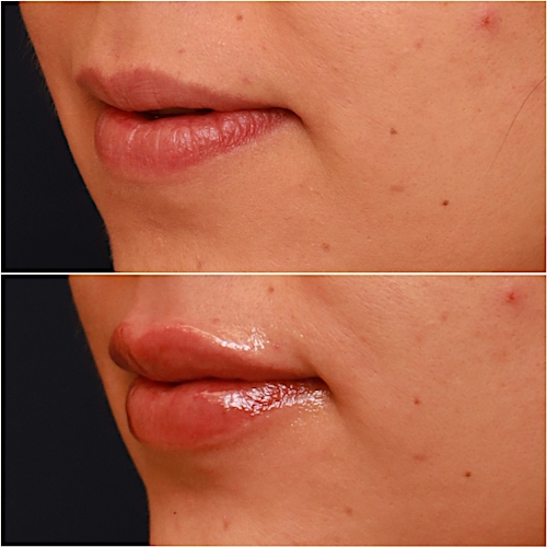 Lip Fillers Before & After Gallery - Patient 58233220 - Image 2