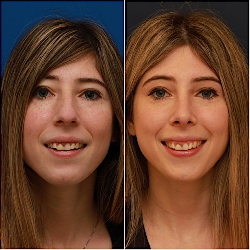 Rhinoplasty Before & After Gallery - Patient 58233250 - Image 2