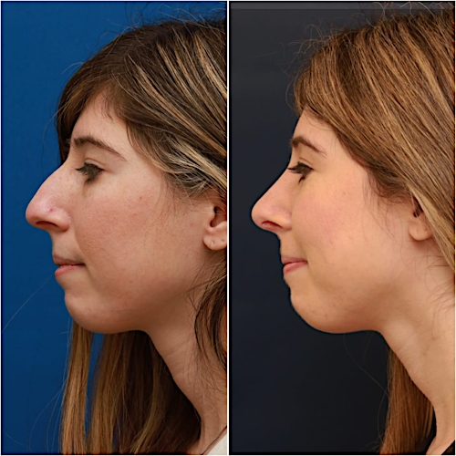 Rhinoplasty Before & After Gallery - Patient 58233250 - Image 3