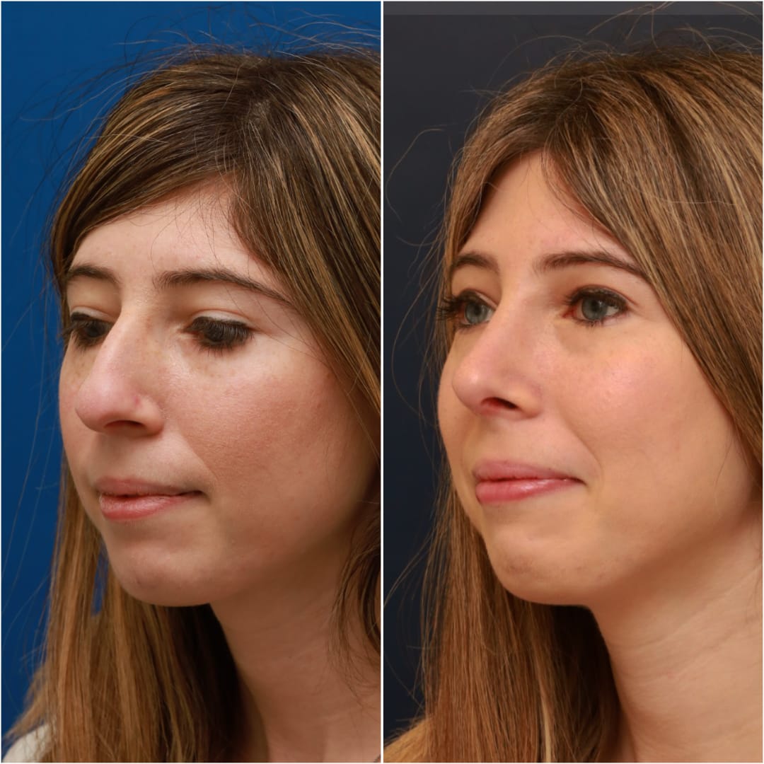Rhinoplasty Before & After Gallery - Patient 58233250 - Image 4