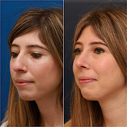 Rhinoplasty Before & After Gallery - Patient 58233250 - Image 4