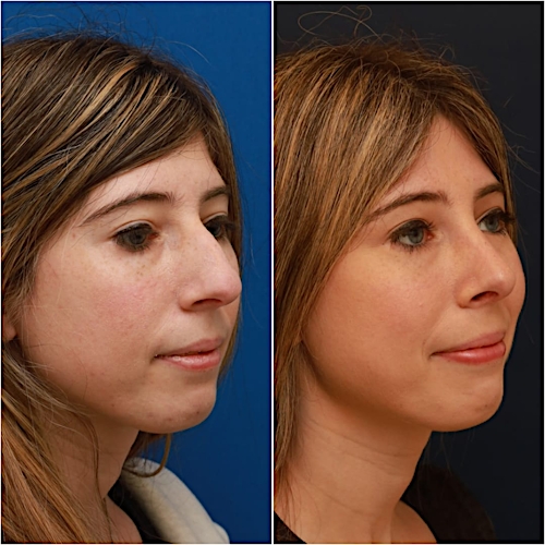 Rhinoplasty Before & After Gallery - Patient 58233250 - Image 5