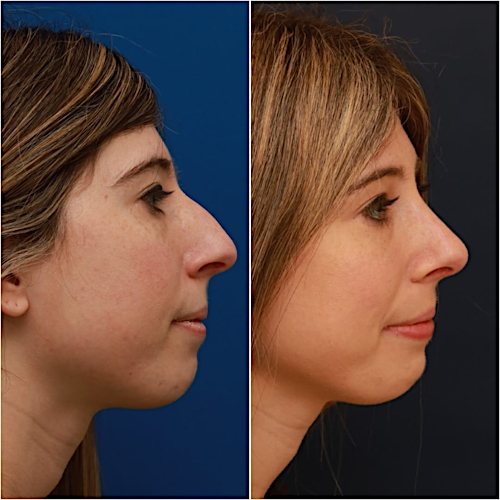 Rhinoplasty Before & After Gallery - Patient 58233250 - Image 1