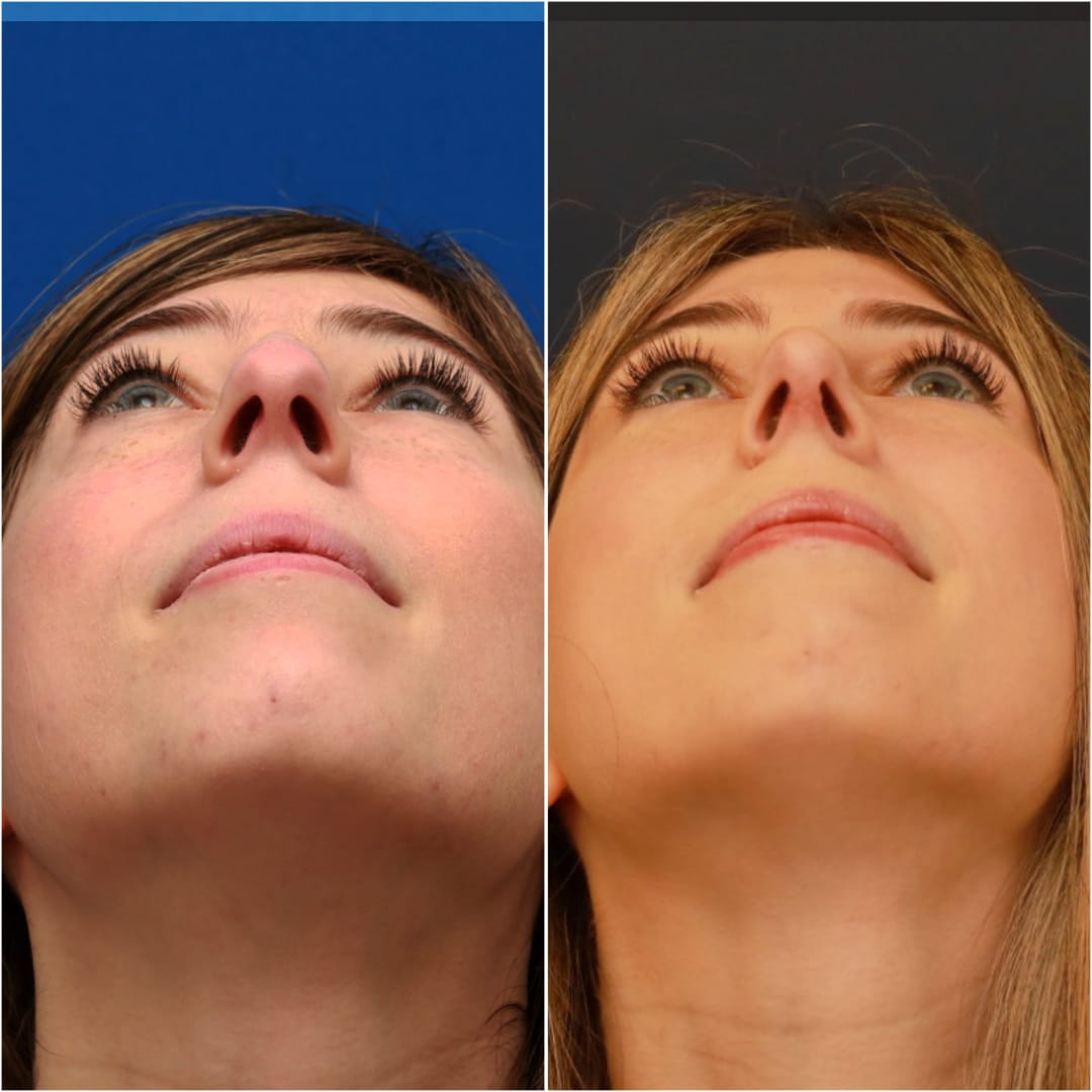 Rhinoplasty Before & After Gallery - Patient 58233250 - Image 6