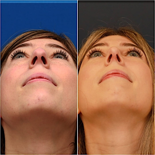 Rhinoplasty Before & After Gallery - Patient 58233250 - Image 6