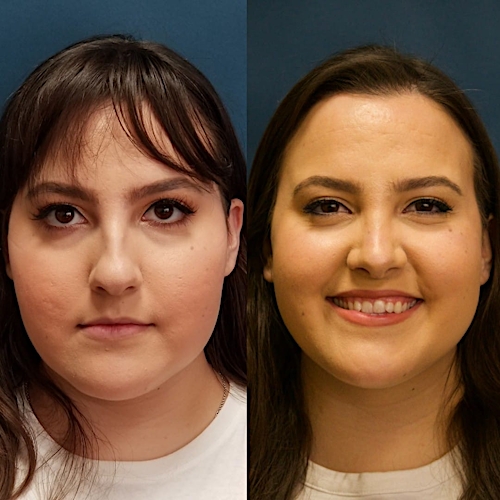 Rhinoplasty Before & After Gallery - Patient 58233251 - Image 2