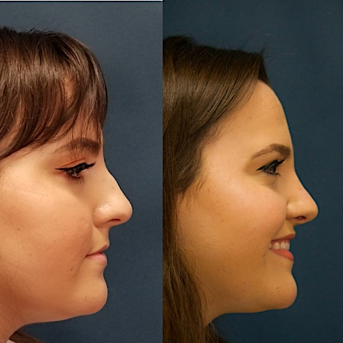 Rhinoplasty Before & After Gallery - Patient 58233251 - Image 1