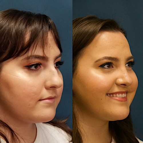 Rhinoplasty Before & After Gallery - Patient 58233251 - Image 3