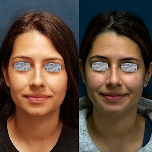 Rhinoplasty Before & After Gallery - Patient 58233252 - Image 2