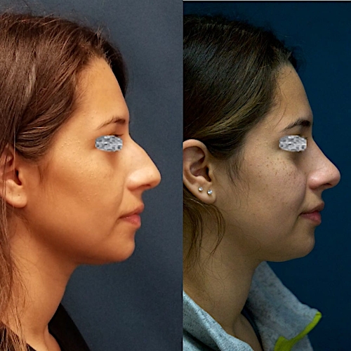 Rhinoplasty Before & After Gallery - Patient 58233252 - Image 1