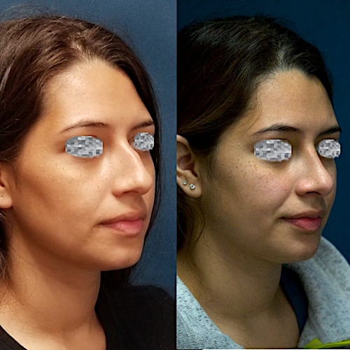 Rhinoplasty Before & After Gallery - Patient 58233252 - Image 3