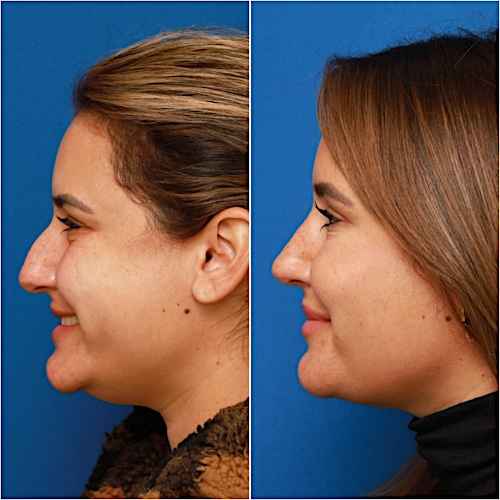Rhinoplasty Before & After Gallery - Patient 58233253 - Image 2