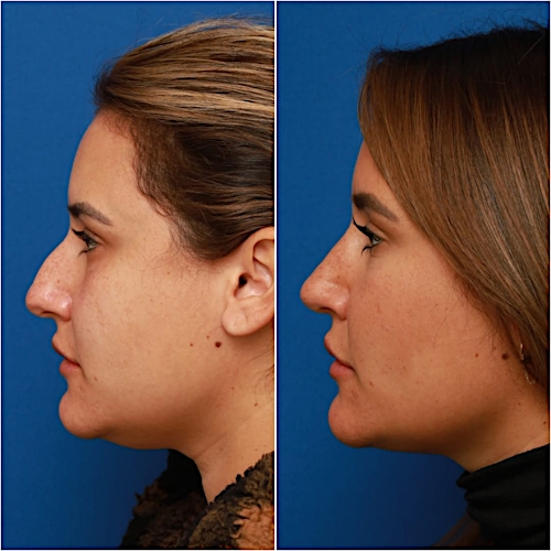 Rhinoplasty Before & After Gallery - Patient 58233253 - Image 3