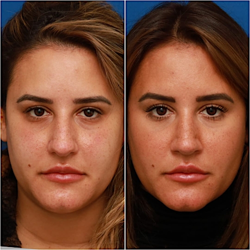 Rhinoplasty Before & After Gallery - Patient 58233253 - Image 4