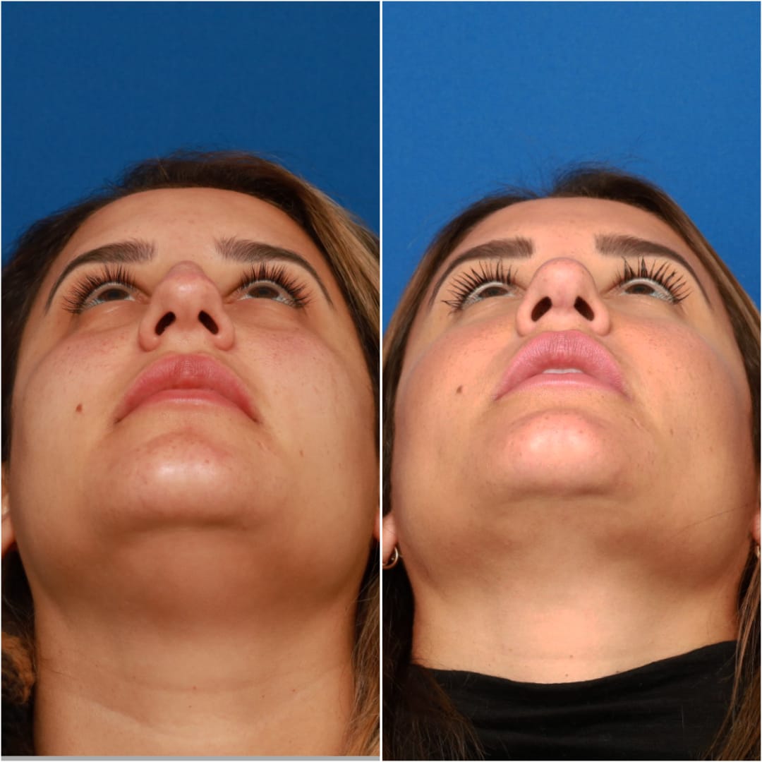 Rhinoplasty Before & After Gallery - Patient 58233253 - Image 5