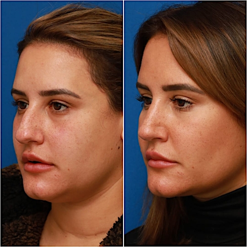 Rhinoplasty Before & After Gallery - Patient 58233253 - Image 6