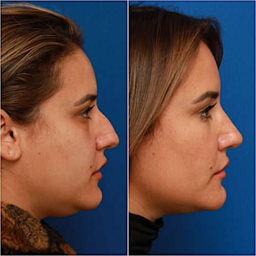 Rhinoplasty Before & After Gallery - Patient 58233253 - Image 1