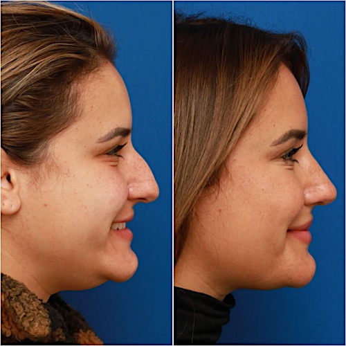 Rhinoplasty Before & After Gallery - Patient 58233253 - Image 7