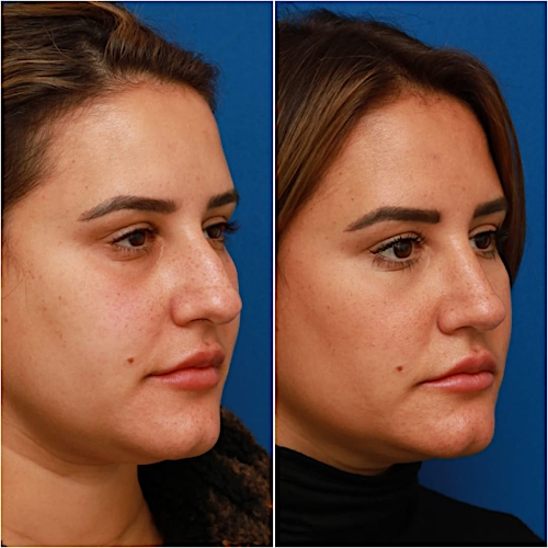 Rhinoplasty Before & After Gallery - Patient 58233253 - Image 8