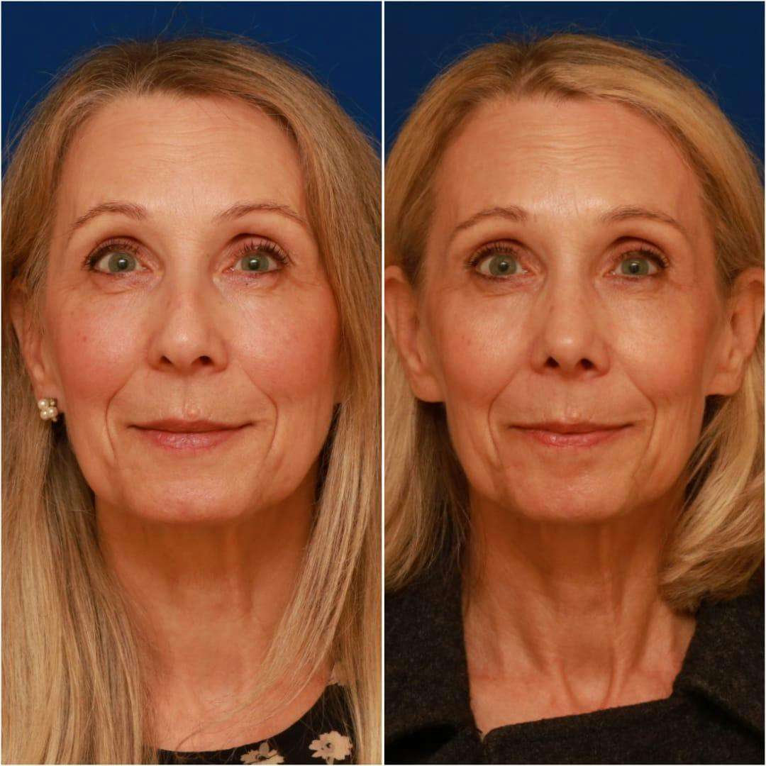 Rhinoplasty Before & After Gallery - Patient 58233304 - Image 2