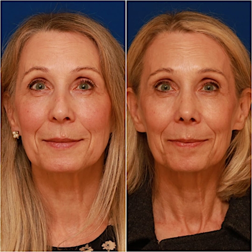 Rhinoplasty Before & After Gallery - Patient 58233304 - Image 2