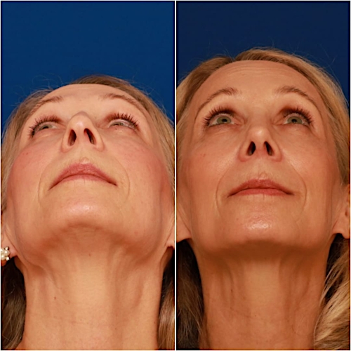 Rhinoplasty Before & After Gallery - Patient 58233304 - Image 3
