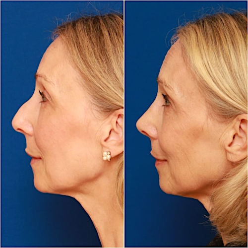 Rhinoplasty Before & After Gallery - Patient 58233304 - Image 4