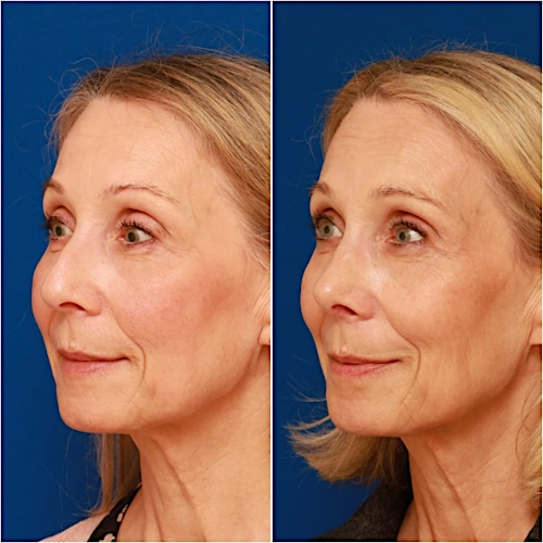 Rhinoplasty Before & After Gallery - Patient 58233304 - Image 5