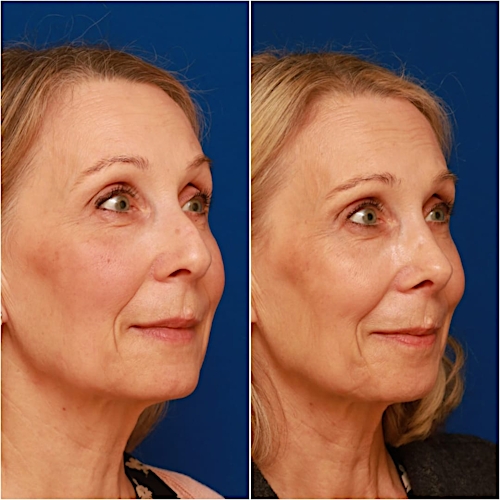 Rhinoplasty Before & After Gallery - Patient 58233304 - Image 6