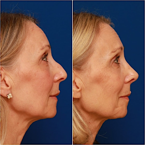 Rhinoplasty Before & After Gallery - Patient 58233304 - Image 1
