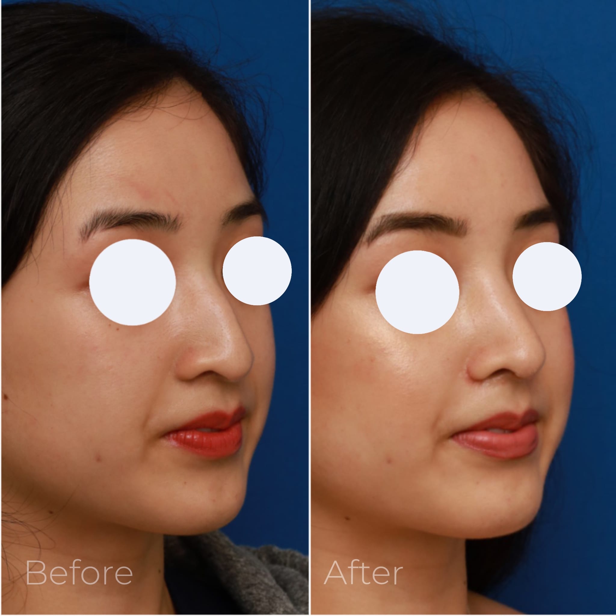 Rhinoplasty Before & After Gallery - Patient 58233305 - Image 2