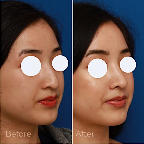 Rhinoplasty Before & After Gallery - Patient 58233305 - Image 2