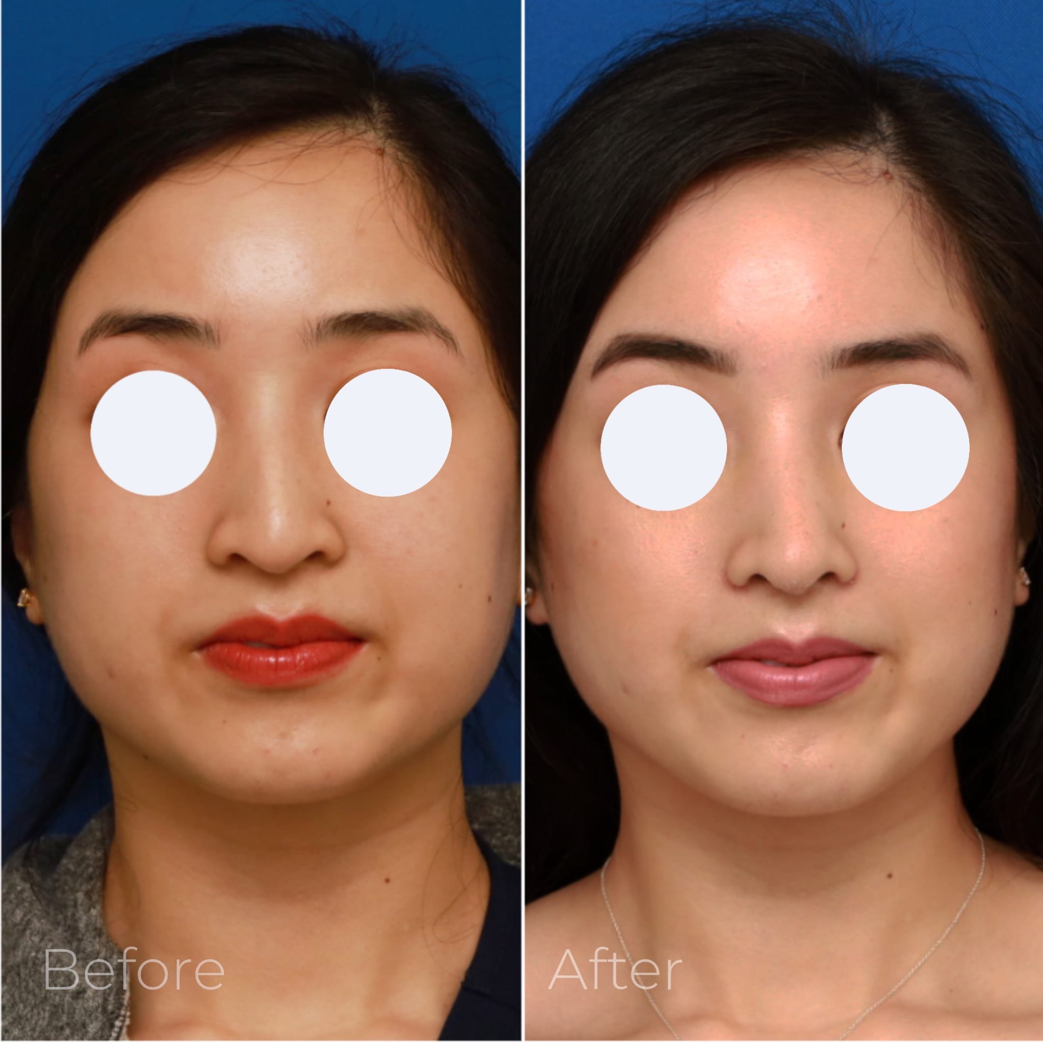 Rhinoplasty Before & After Gallery - Patient 58233305 - Image 3