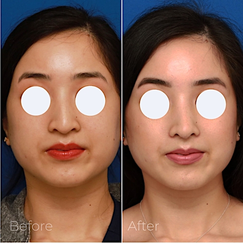 Rhinoplasty Before & After Gallery - Patient 58233305 - Image 3