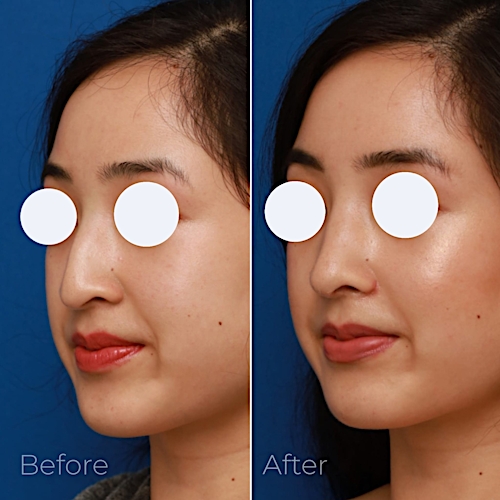 Rhinoplasty Before & After Gallery - Patient 58233305 - Image 4