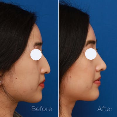 Rhinoplasty Before & After Gallery - Patient 58233305 - Image 1