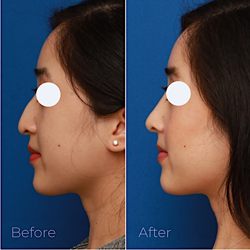 Rhinoplasty Before & After Gallery - Patient 58233305 - Image 5