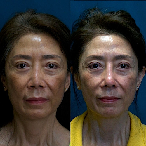 Rhinoplasty Before & After Gallery - Patient 58233306 - Image 2