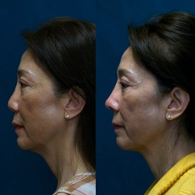 Revision Rhinoplasty Before & After Gallery - Patient 58241501 - Image 1