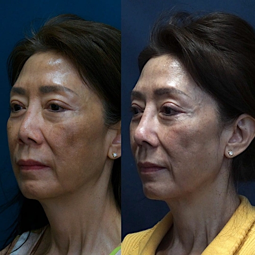 Rhinoplasty Before & After Gallery - Patient 58233306 - Image 3