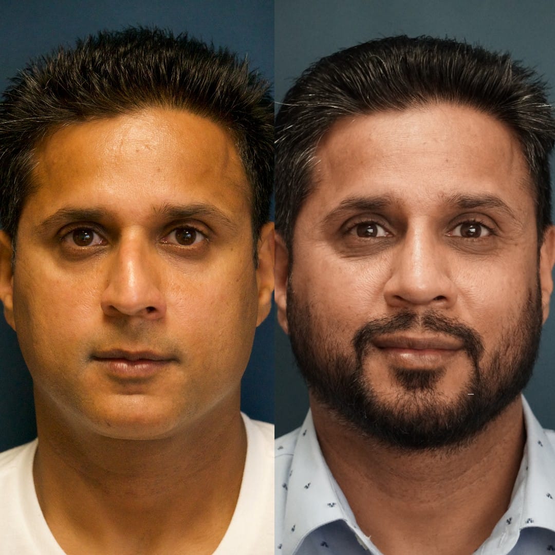 Revision Rhinoplasty Before & After Gallery - Patient 58241516 - Image 3