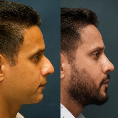 Rhinoplasty Before & After Gallery - Patient 58233307 - Image 1