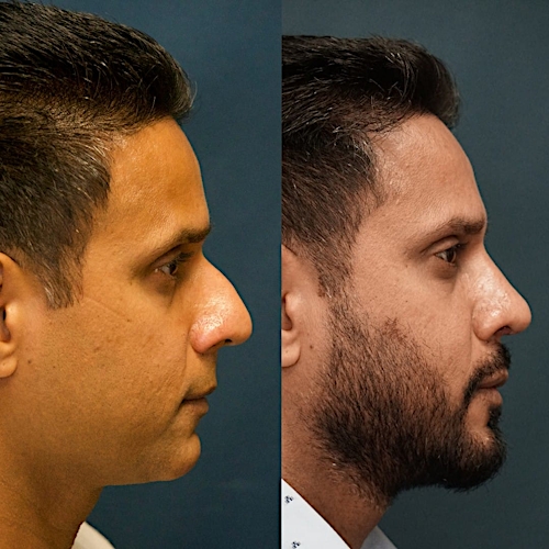 Revision Rhinoplasty Before & After Gallery - Patient 58241516 - Image 1